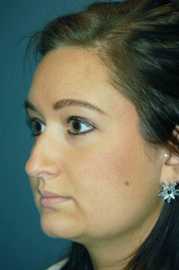 Rhinoplasty Before & After Gallery - Patient 4521037 - Image 1
