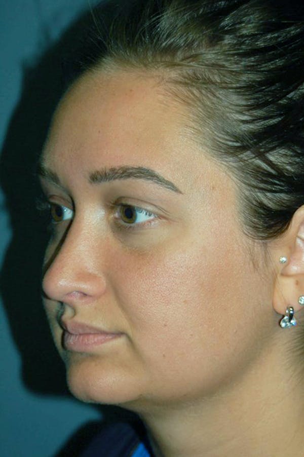Rhinoplasty Before & After Gallery - Patient 4521037 - Image 2
