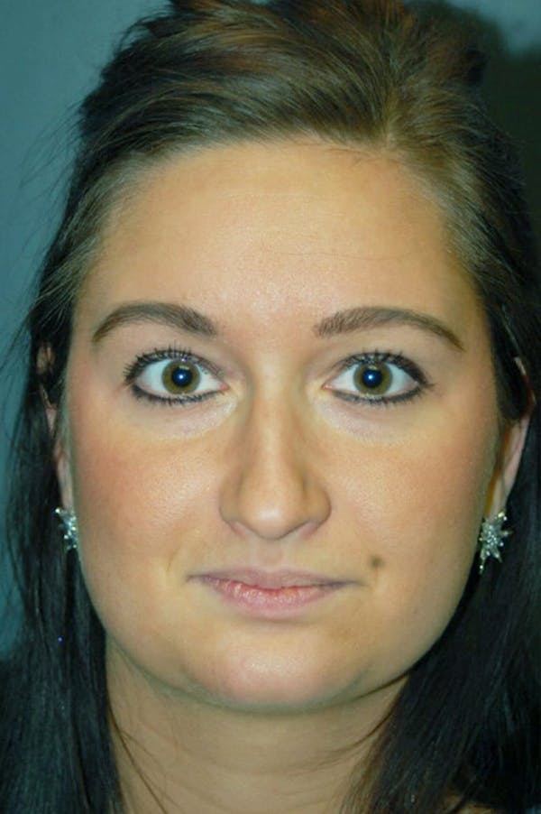 Rhinoplasty Before & After Gallery - Patient 4521037 - Image 7