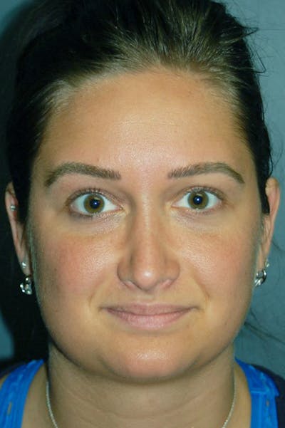 Rhinoplasty Before & After Gallery - Patient 4521037 - Image 8