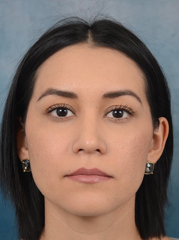 Rhinoplasty Before & After Gallery - Patient 13573466 - Image 4