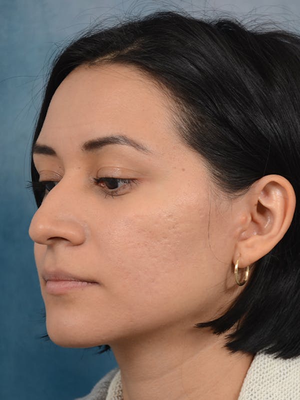 Rhinoplasty Before & After Gallery - Patient 13573466 - Image 5