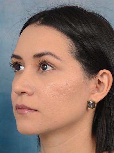 Rhinoplasty Before & After Gallery - Patient 13573466 - Image 6