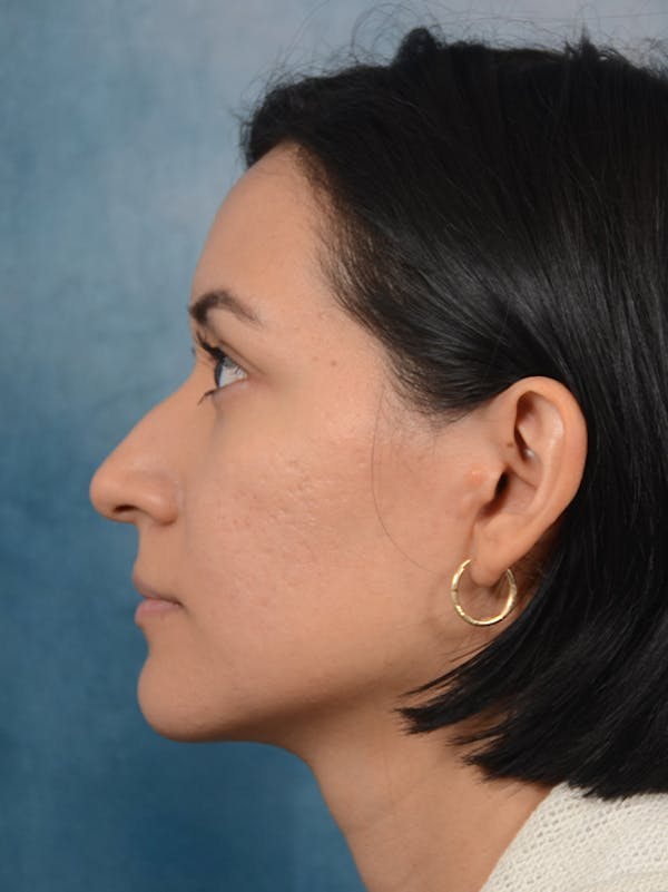 Rhinoplasty Before & After Gallery - Patient 13573466 - Image 1
