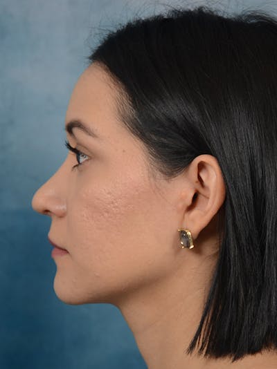 Rhinoplasty Before & After Gallery - Patient 13573466 - Image 2
