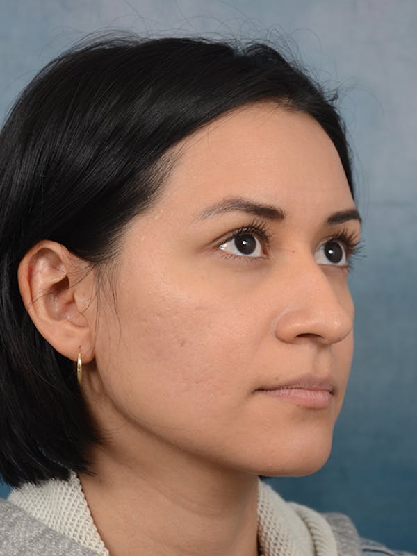 Rhinoplasty Before & After Gallery - Patient 13573466 - Image 7