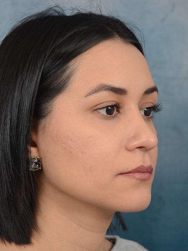 Rhinoplasty Before & After Gallery - Patient 13573466 - Image 8