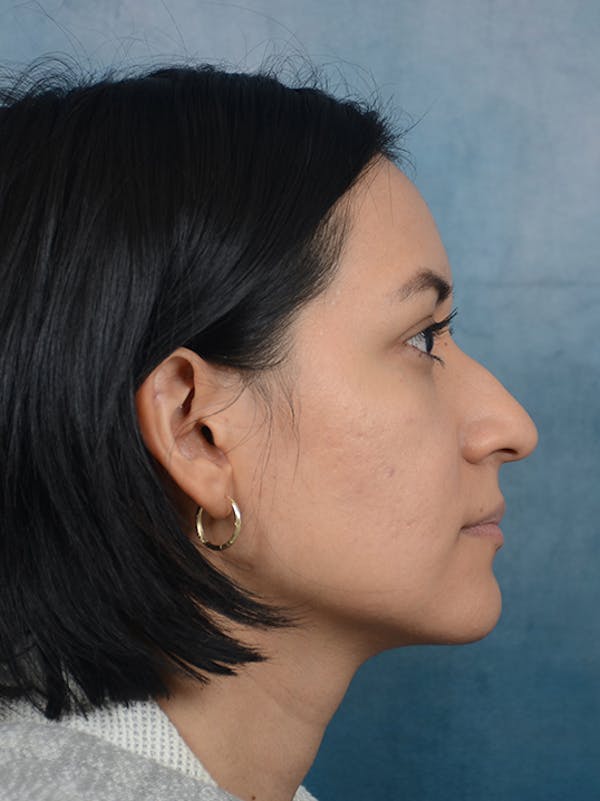 Rhinoplasty Before & After Gallery - Patient 13573466 - Image 9