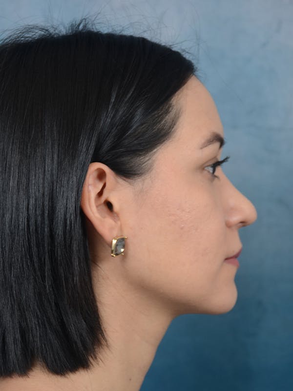 Rhinoplasty Before & After Gallery - Patient 13573466 - Image 10