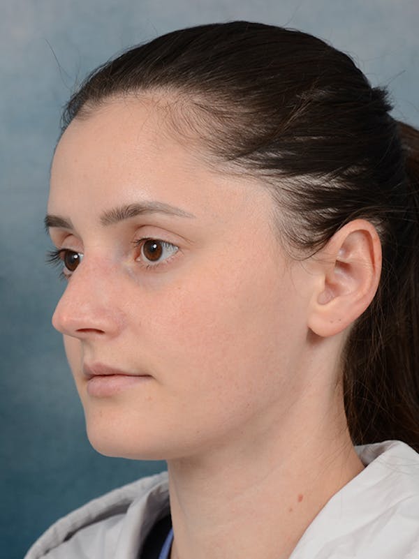 Rhinoplasty Before & After Gallery - Patient 13736918 - Image 5