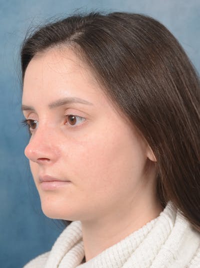 Rhinoplasty Before & After Gallery - Patient 13736918 - Image 6