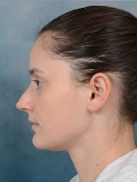 Rhinoplasty Before & After Gallery - Patient 13736918 - Image 1