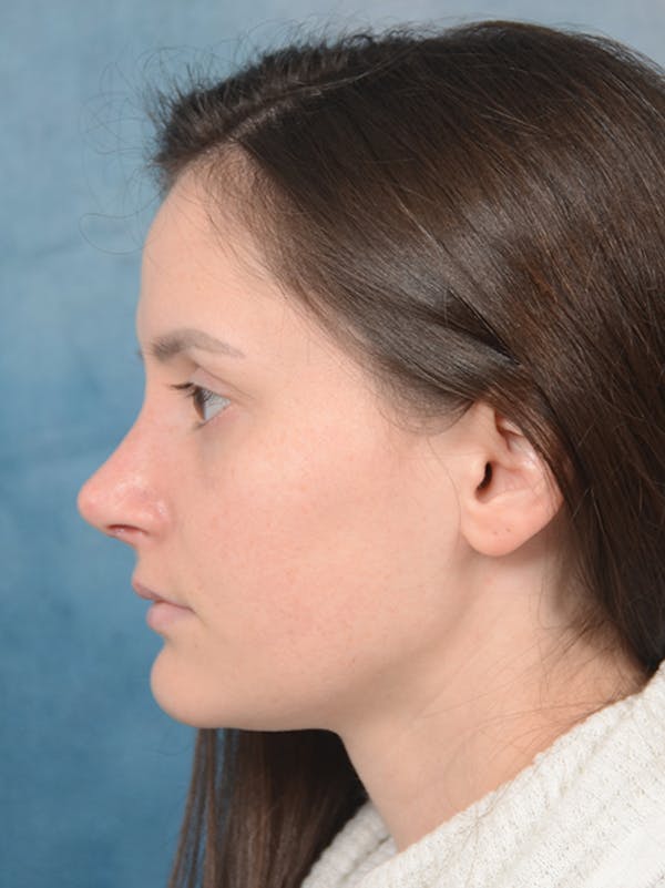 Rhinoplasty Before & After Gallery - Patient 13736918 - Image 2