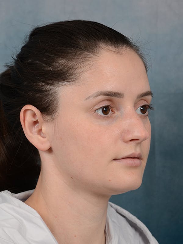 Rhinoplasty Before & After Gallery - Patient 13736918 - Image 7