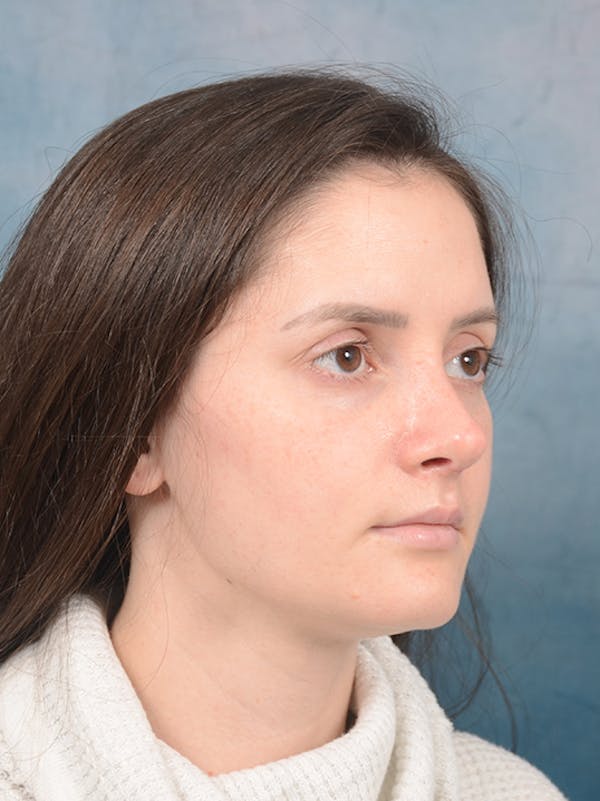 Rhinoplasty Before & After Gallery - Patient 13736918 - Image 8
