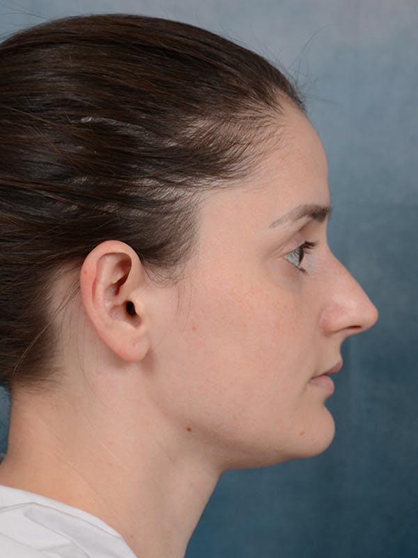 Rhinoplasty Before & After Gallery - Patient 13736918 - Image 9