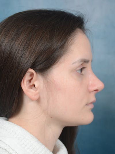 Rhinoplasty Before & After Gallery - Patient 13736918 - Image 10