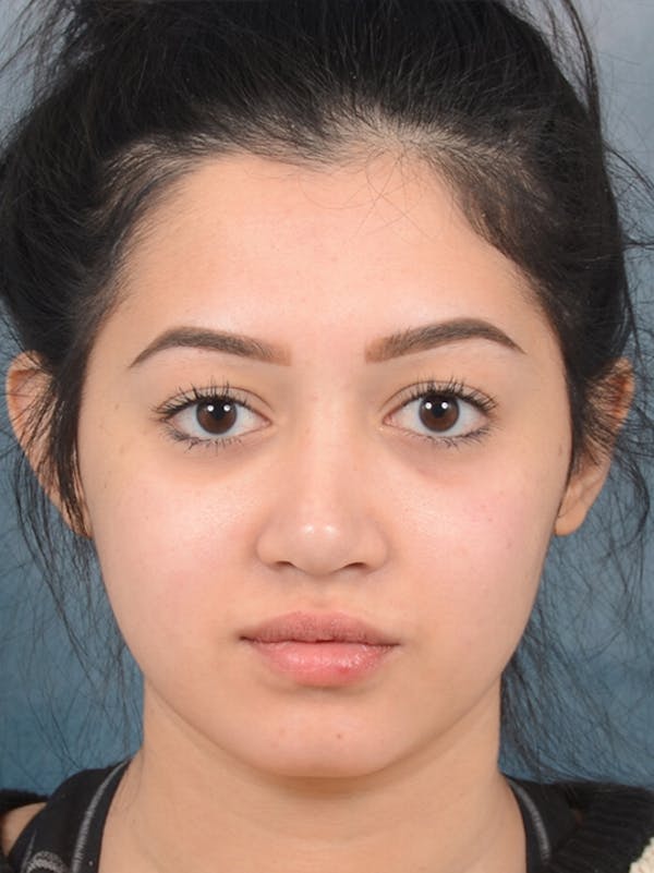 Rhinoplasty Before & After Gallery - Patient 14136151 - Image 4