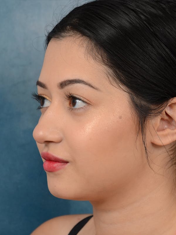 Rhinoplasty Before & After Gallery - Patient 14136151 - Image 5