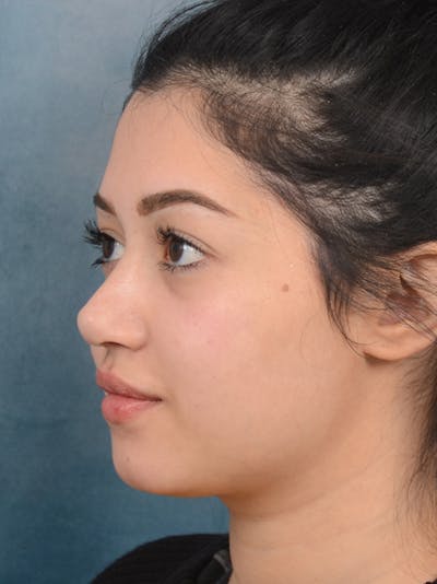 Rhinoplasty Before & After Gallery - Patient 14136151 - Image 6