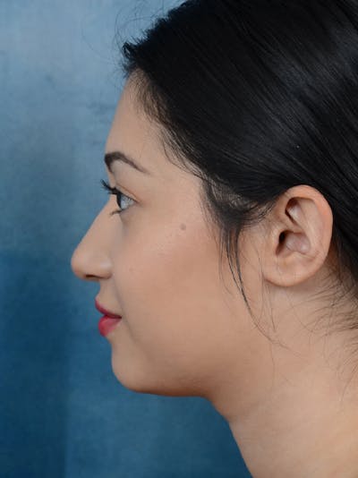 Rhinoplasty Before & After Gallery - Patient 14136151 - Image 1