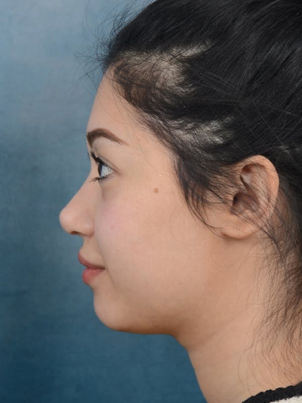 Rhinoplasty Before & After Gallery - Patient 14136151 - Image 2