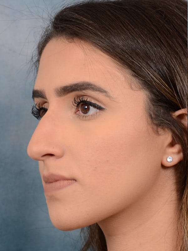 Rhinoplasty Before & After Gallery - Patient 14136199 - Image 5