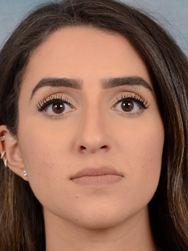 Rhinoplasty Before & After Gallery - Patient 14136199 - Image 3