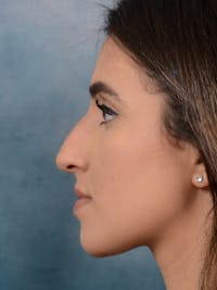 Rhinoplasty Before & After Gallery - Patient 14136199 - Image 1