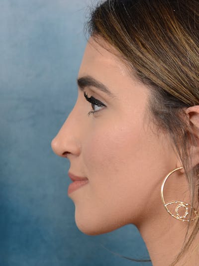 Rhinoplasty Before & After Gallery - Patient 14136199 - Image 2