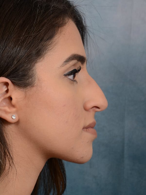 Rhinoplasty Before & After Gallery - Patient 14136199 - Image 9