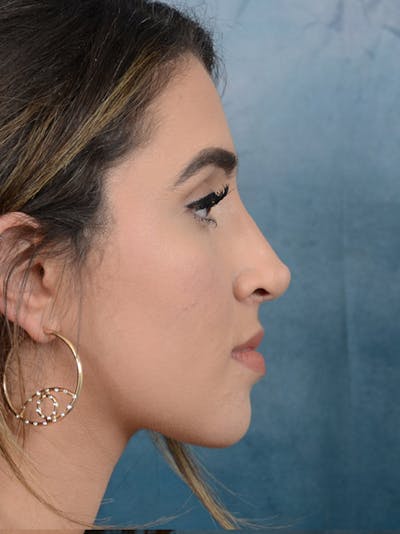 Rhinoplasty Before & After Gallery - Patient 14136199 - Image 10