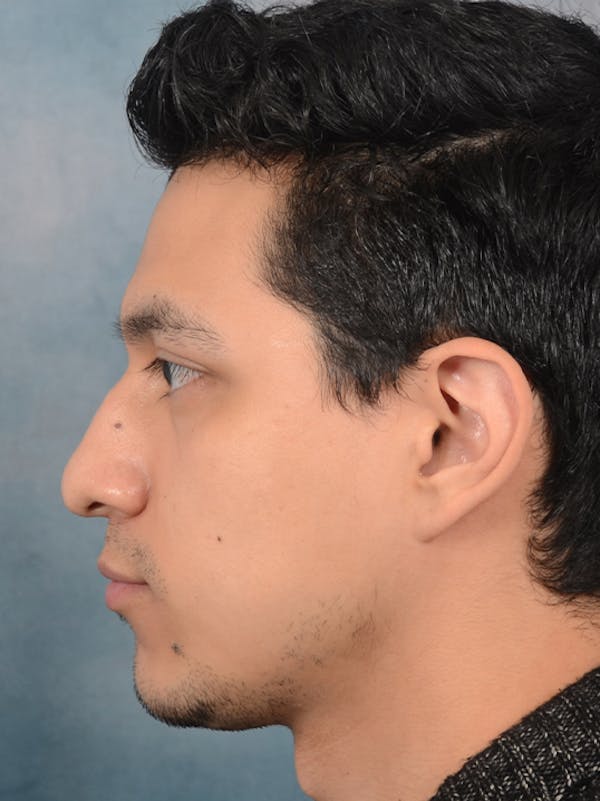 Rhinoplasty Before & After Gallery - Patient 14391241 - Image 1