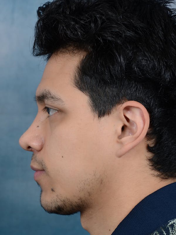 Rhinoplasty Before & After Gallery - Patient 14391241 - Image 2