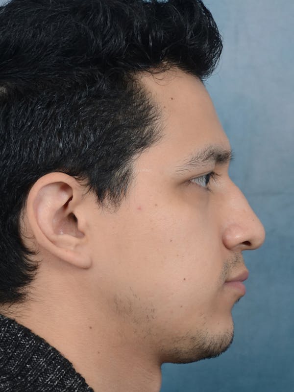 Rhinoplasty Before & After Gallery - Patient 14391241 - Image 9