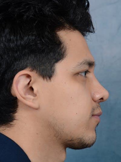 Rhinoplasty Before & After Gallery - Patient 14391241 - Image 10