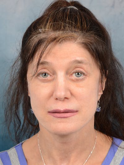 Deep Plane Facelift Before & After Gallery - Patient 14605187 - Image 4