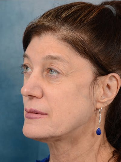 Deep Plane Facelift Before & After Gallery - Patient 14605187 - Image 1