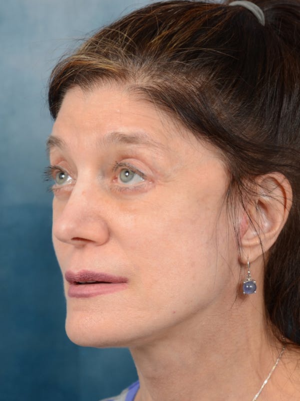 Deep Plane Facelift Before & After Gallery - Patient 14605187 - Image 2