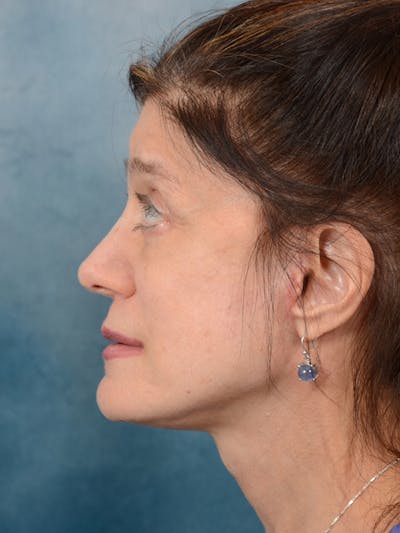 Deep Plane Facelift Before & After Gallery - Patient 14605187 - Image 6