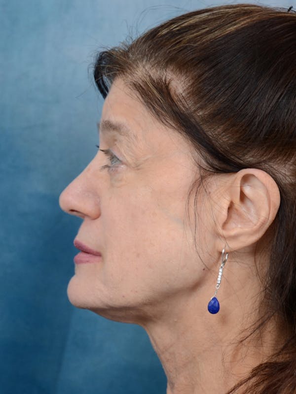 Deep Plane Facelift Before & After Gallery - Patient 14605187 - Image 5