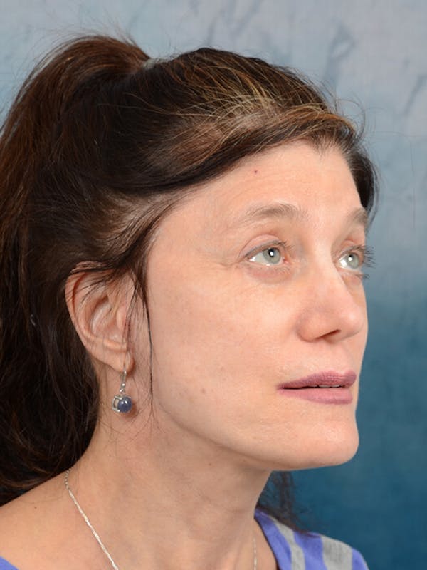 Deep Plane Facelift Before & After Gallery - Patient 14605187 - Image 8
