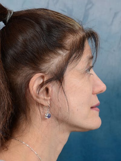 Deep Plane Facelift Before & After Gallery - Patient 14605187 - Image 10