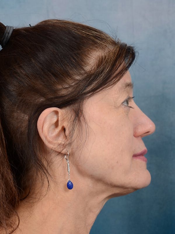 Deep Plane Facelift Before & After Gallery - Patient 14605187 - Image 9