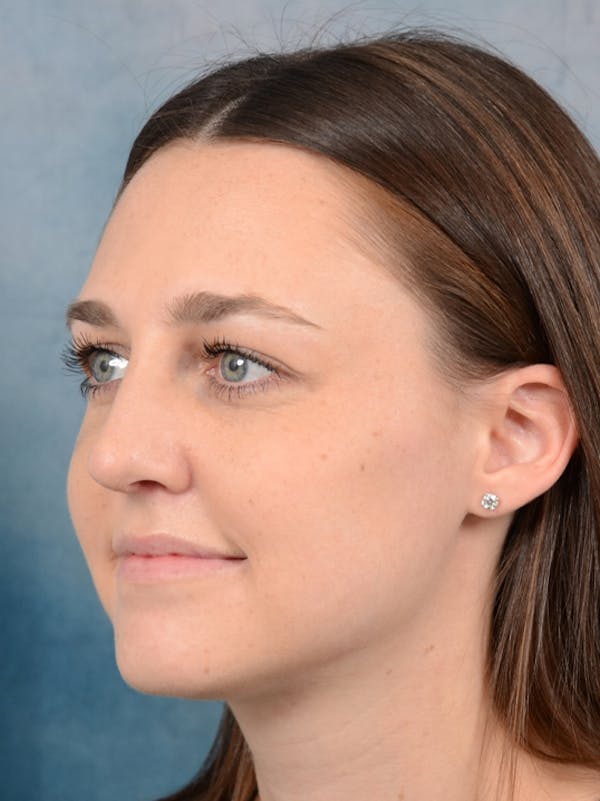 Rhinoplasty Before & After Gallery - Patient 15238973 - Image 6