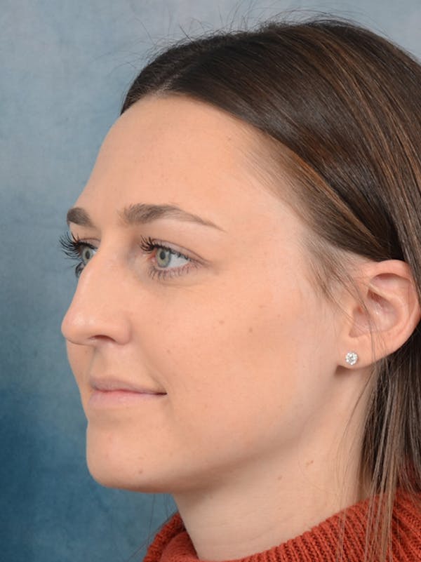 Rhinoplasty Before & After Gallery - Patient 15238973 - Image 5