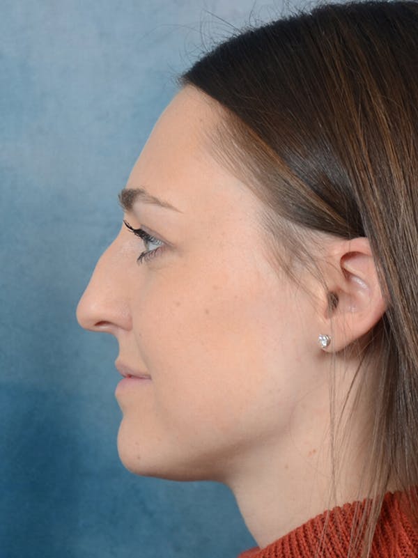 Rhinoplasty Before & After Gallery - Patient 15238973 - Image 1