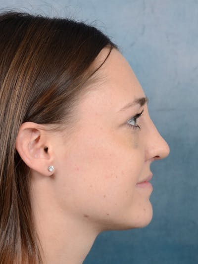 Rhinoplasty Before & After Gallery - Patient 15238973 - Image 8
