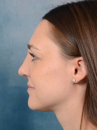 Rhinoplasty Before & After Gallery - Patient 15238973 - Image 2