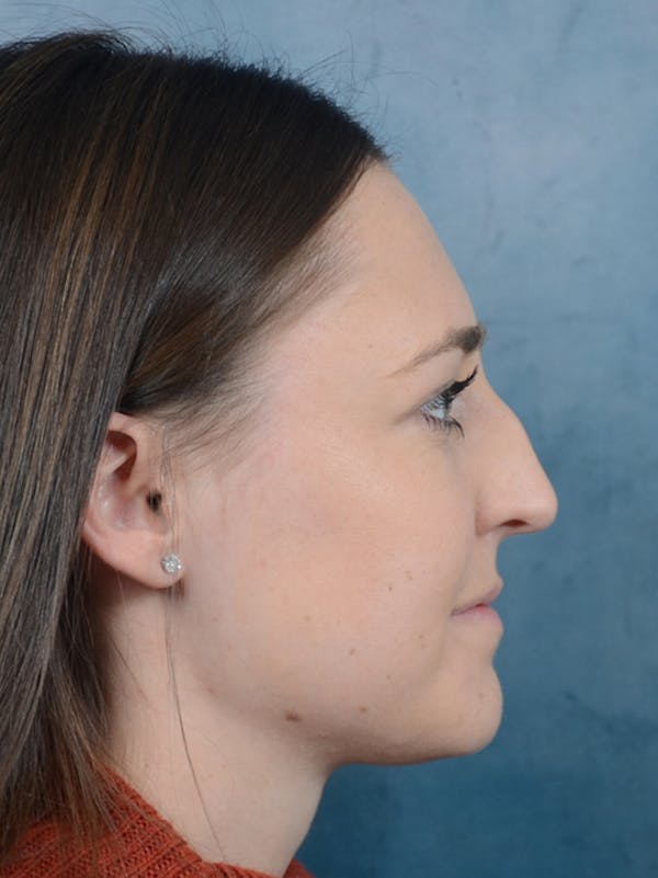 Rhinoplasty Before & After Gallery - Patient 15238973 - Image 7